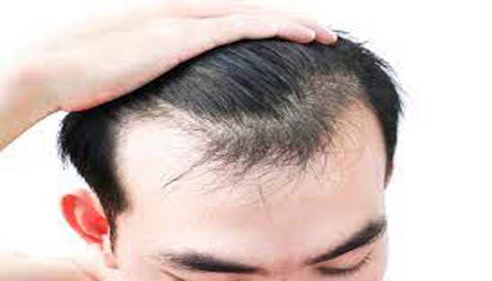 مراقبت از پوست سر و تقویت موها بعد از کاشت