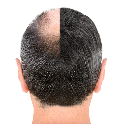 کاشت مو بدون جراحی چگونه است و چه مزایایی دارد؟