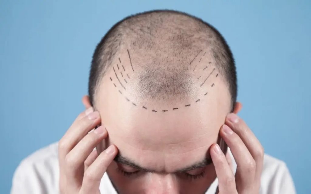 علت ترک خوردن پوست سر بعد از کاشت مو چیست و چگونه برطرف می شود؟
