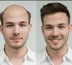 کاشت مو در مردان