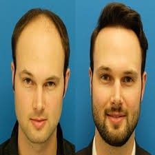 کاشت مو در مردان