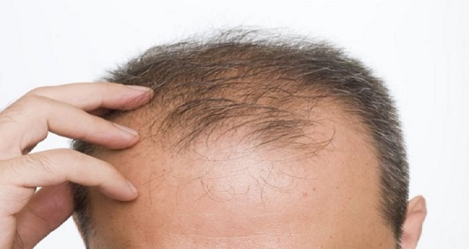 آیا ورم بعد از کاشت مو طبیعی است؟