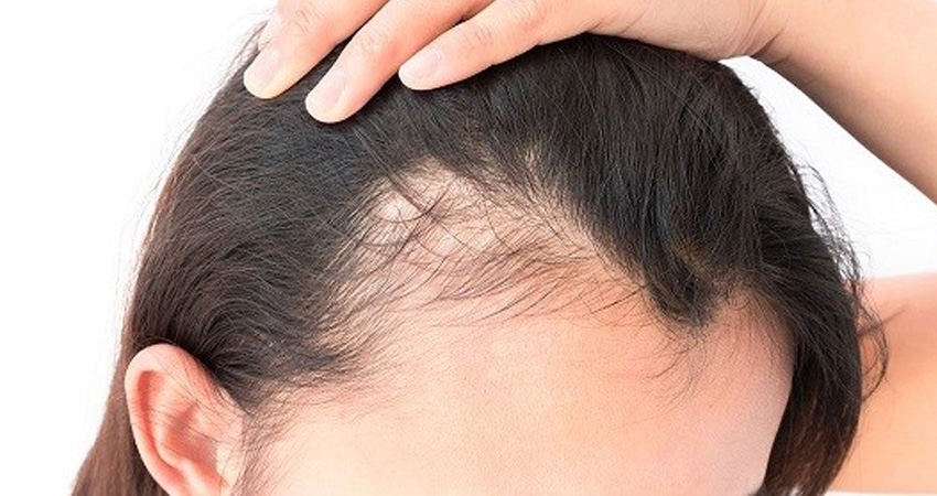 آیا ورم بعد از کاشت مو طبیعی است؟
