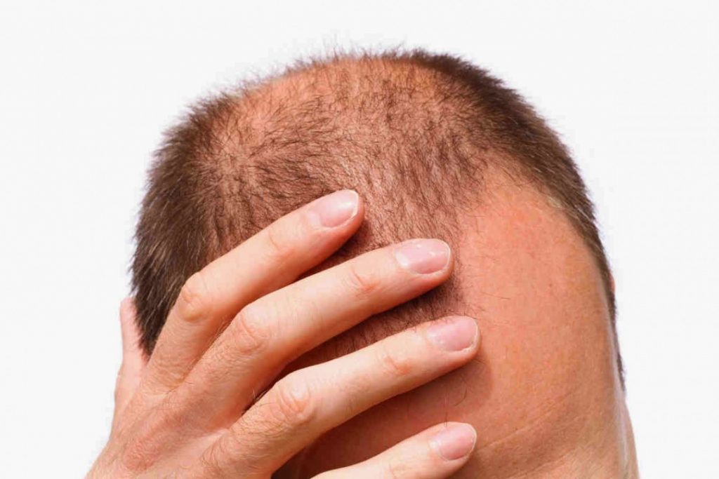 آیا کاشت مو با بانک موی دیگران امکان پذیر است؟