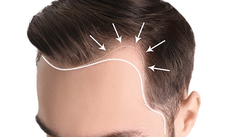 علت رخ دادن عوارض کاشت مو چیست؟