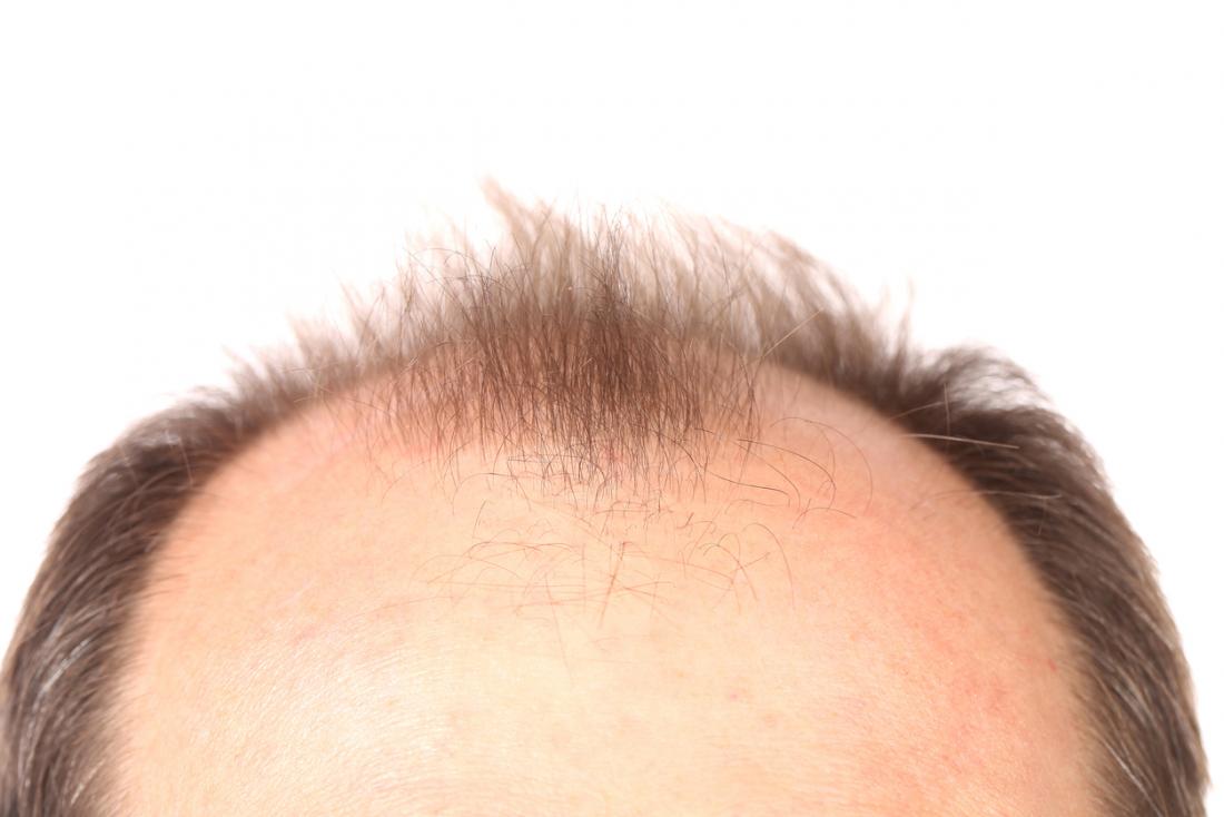 راه حل دائمی ریزش مو چیست؟