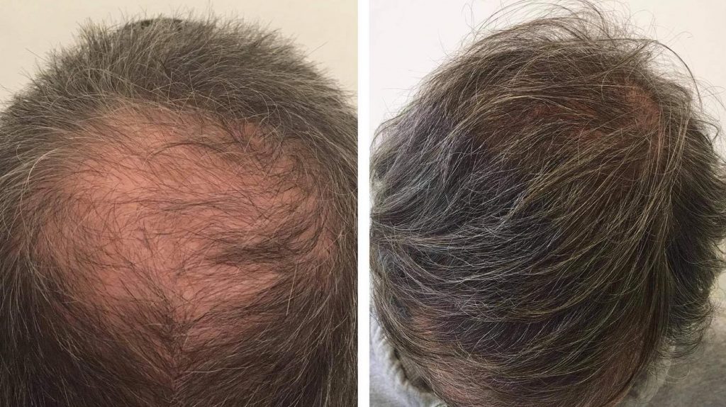  خطرات و عوارض جانبی کاشت مو در ناحیه ورتکس