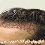 کاشت موی طبیعی کاشت مو برای بیماران هپاتیتی و ایدزی