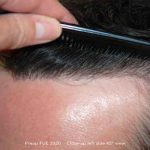 بررسی کاشت مو به روش سوپر ترکیبی