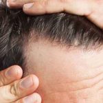 کاشت مو با سلولهای بنیادی چگونه است؟