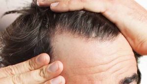 کاشت مو با سلولهای بنیادی چگونه است؟