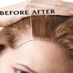 اقدامات احتیاطی بعد از عمل کاشت مو کاشت مو به روش sut برای زنان