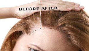 اقدامات احتیاطی بعد از عمل کاشت مو کاشت مو به روش sut برای زنان