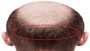 روش کاشت مو برای بانک موی ضعیف