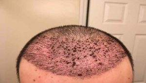 قرمزی سر بعد از کاشت مو