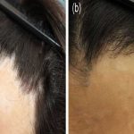 روش های غیر جراحی برای ترمیم مو در جاهای سوخته شده تفاوت ترمیم و کاشت مو