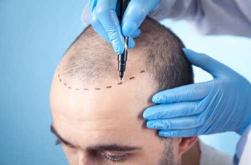 علت رخ دادن عوارض کاشت مو چیست؟