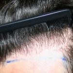 کاشت مو به روشMicro FIT چگونه است؟