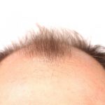 راه حل دائمی ریزش مو چیست؟