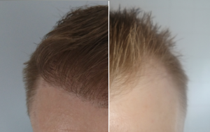 دوره نقاهت بعد از عمل میکروگرافت مو چقدر است؟