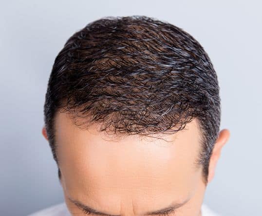 هزینه کاشت مو با سلول های بنیادی چقدر است؟