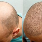 چرا قبل از کاشت مو نیاز به تراشیدن سر داریم؟