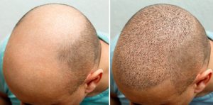 چرا قبل از کاشت مو نیاز به تراشیدن سر داریم؟
